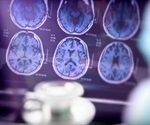 Healthy sleep pattern alleviates some of the symptoms of Alzheimer’s disease