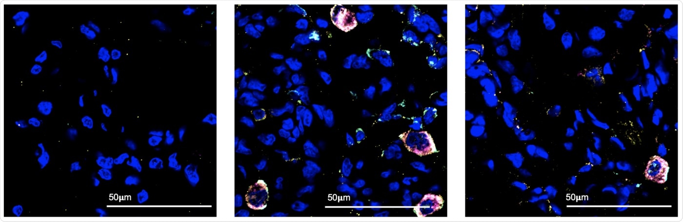 Single-cell sequencing technique helps to examine early SARS-CoV-2 infection