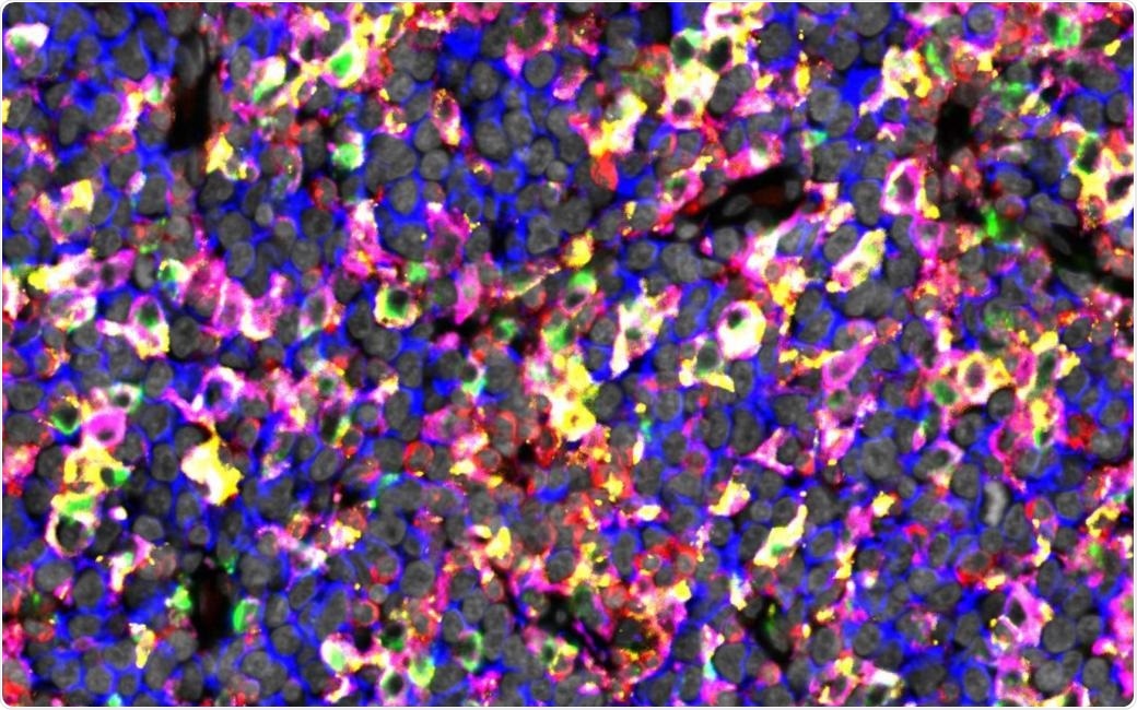 Study decodes the heterogeneity of tumor-infiltrating immune cell composition in diffuse large B-cell lymphoma