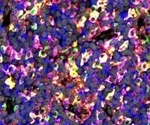 Study decodes the heterogeneity of tumor-infiltrating immune cell composition in diffuse large B-cell lymphoma