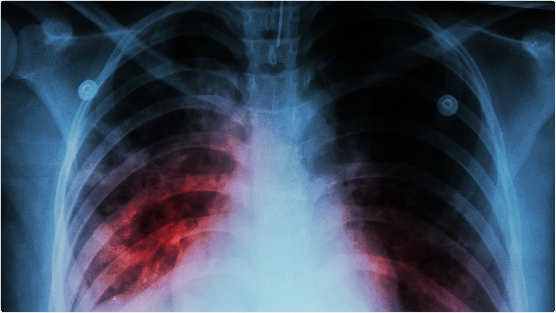 Understanding mutational bias helps scientists predict how pathogens develop resistance to drugs