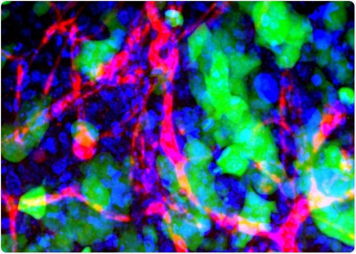 Immune cells leave traces on metastasis in the brain, likely to help future treatments