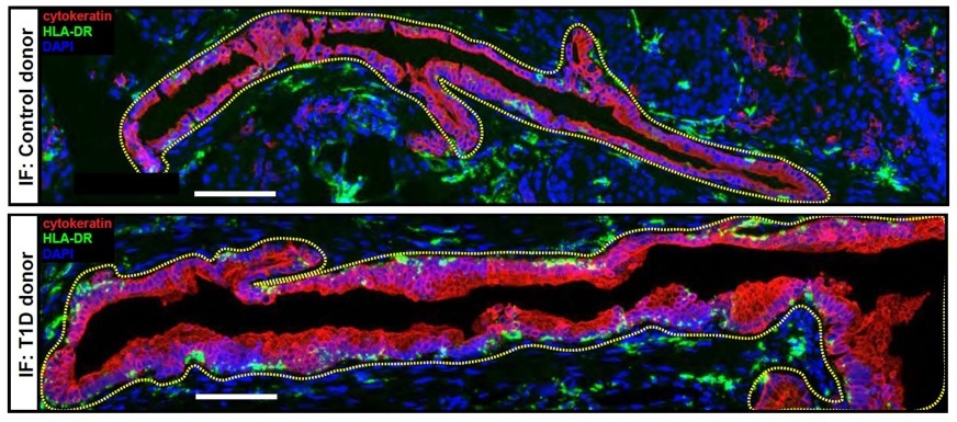 Researchers discover how pancreatic cells remodel themselves to reduce the immune response in patients at risk for T1D