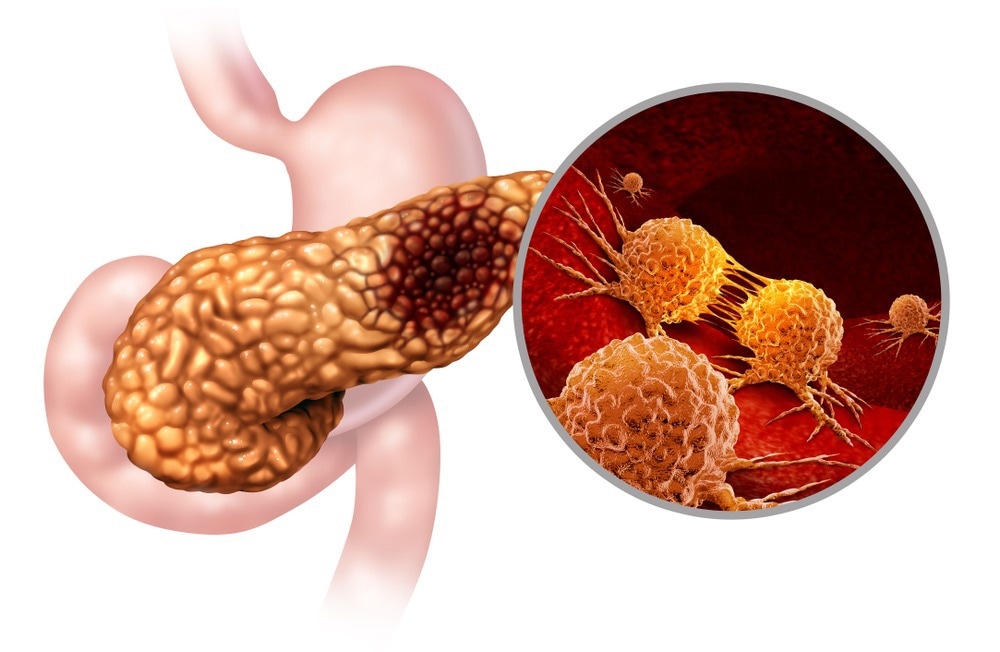 Pancreatic Cancer