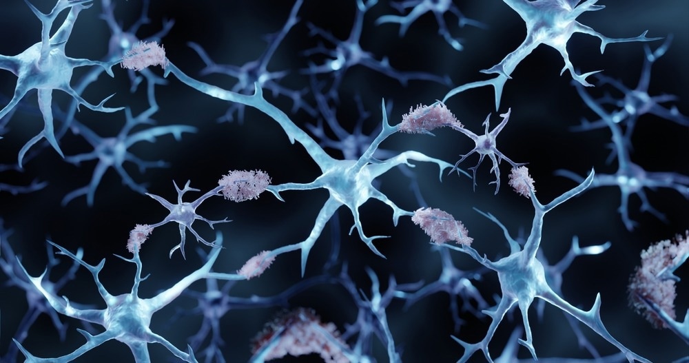 Amyloid Plaques