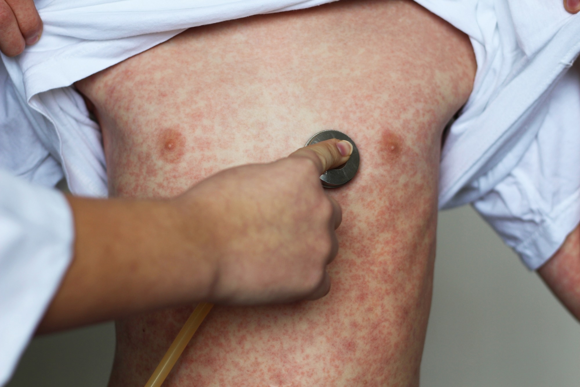 Measles rash