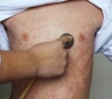 What is Driving the Measles Outbreak Surge in the US In 2025?