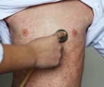 What is Driving the Measles Outbreak Surge in the US In 2025?