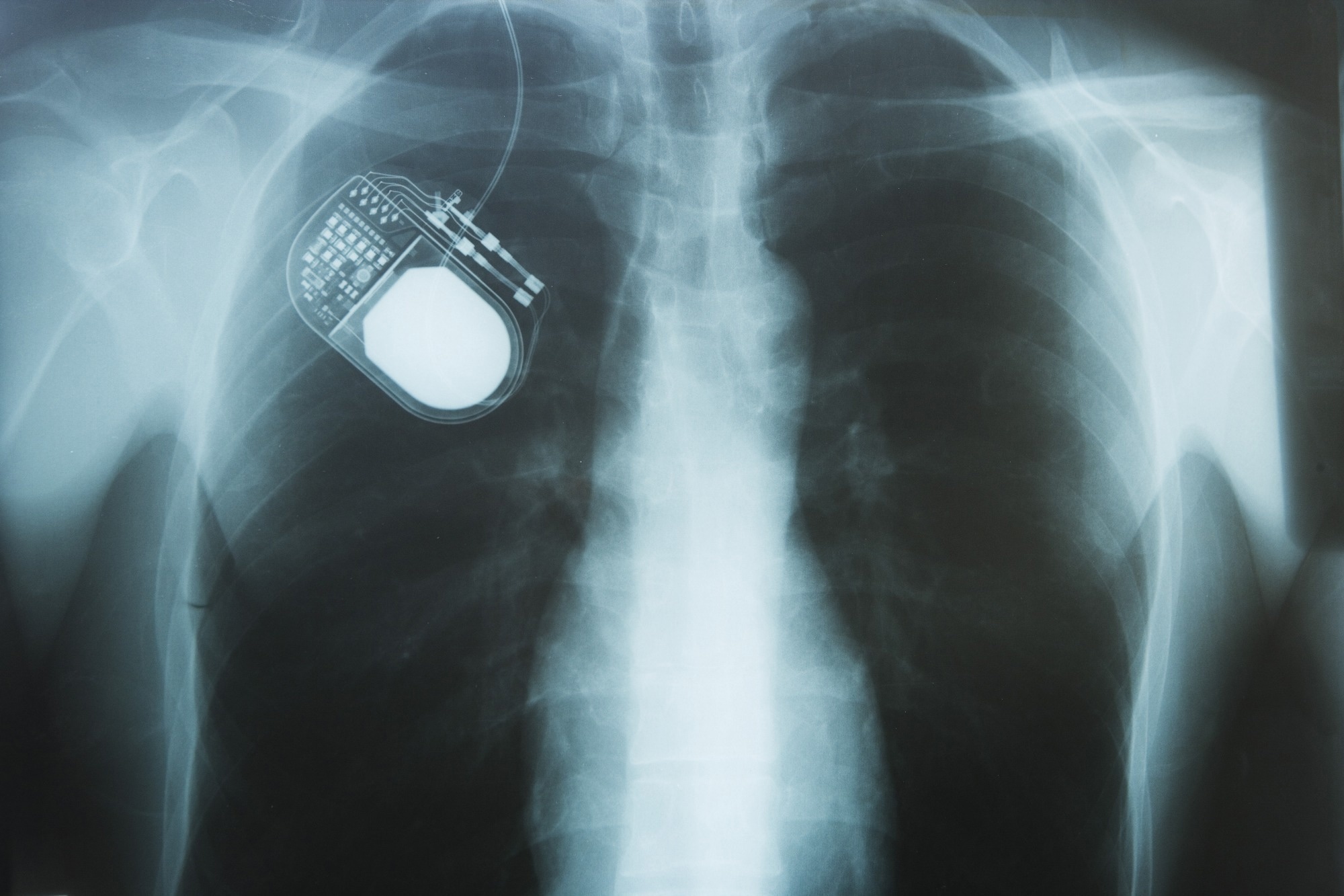 Nerve simulator on chest X-ray