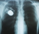 Smart Implants and Closed-Loop Systems: The Next Generation of Therapeutic Devices