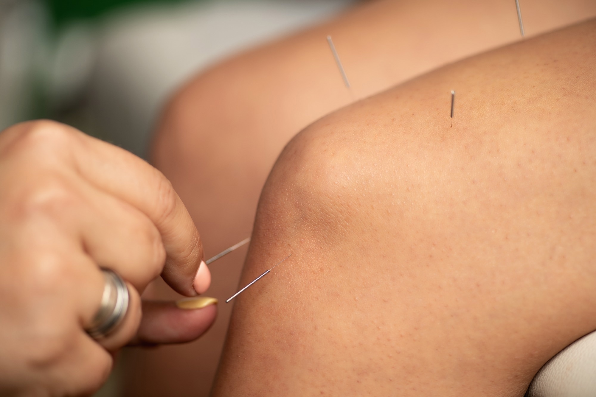 Acupuncture therapy for reducing inflammation in the knee joint