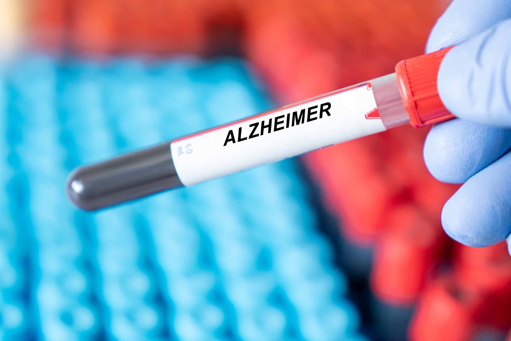 Alzheimer disease blood test in doctor