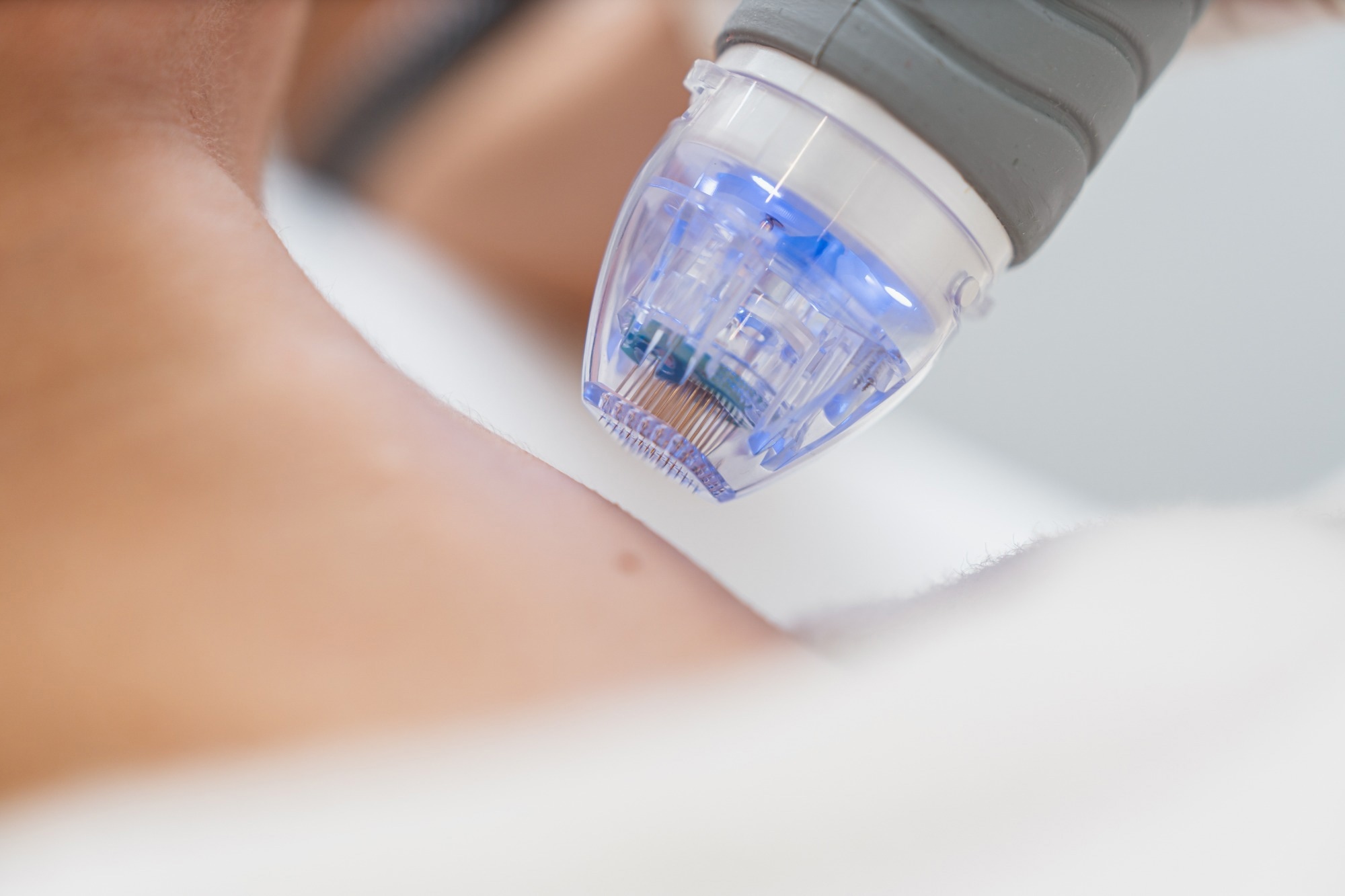 Microneedle RF lifting procedure. Hardware cosmetology. High quality photo
