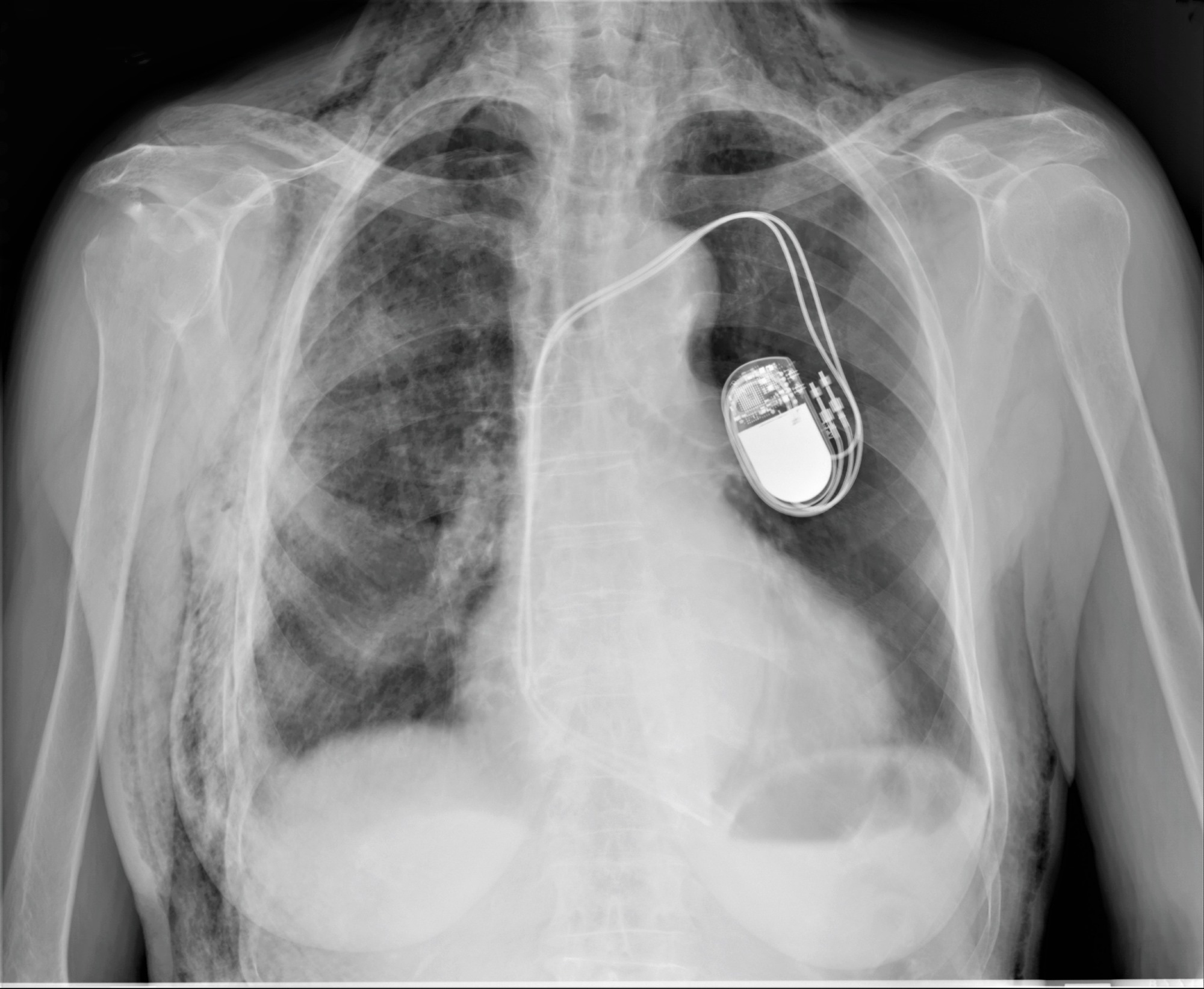Chest X-ray showing an implanted cardiac pacemaker with leads extending into the heart.