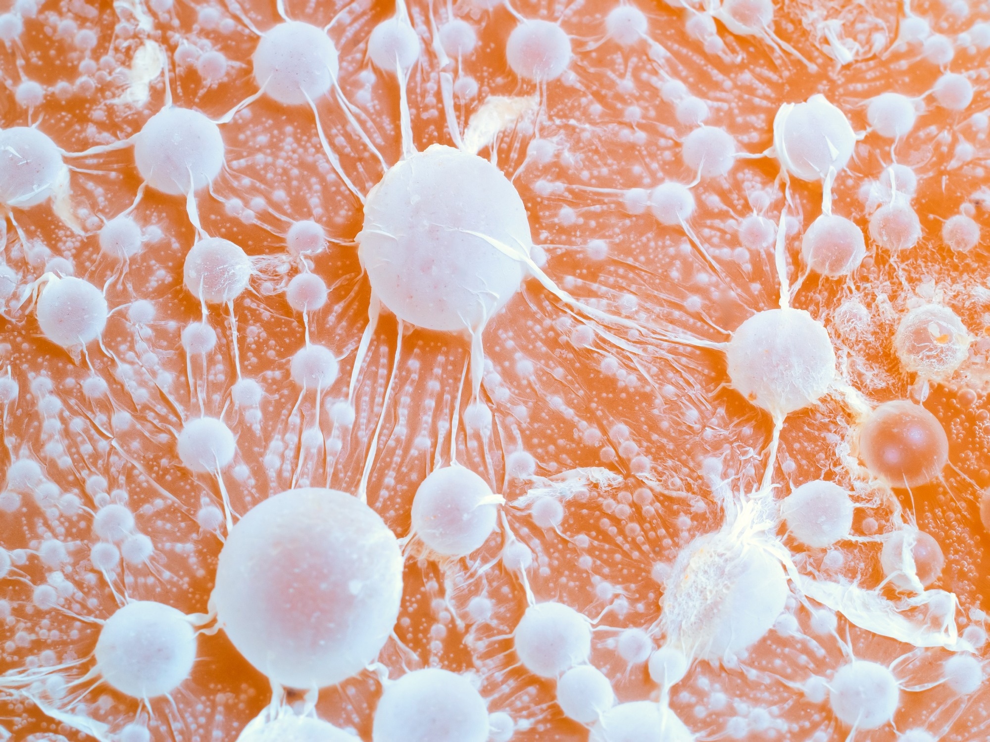 cancer tumour. tumors with metastases close up.