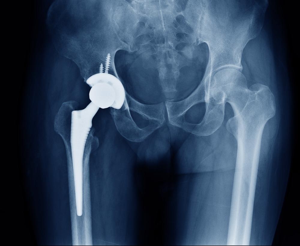 Implant