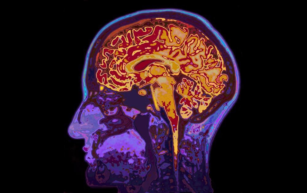 MRI of Brain