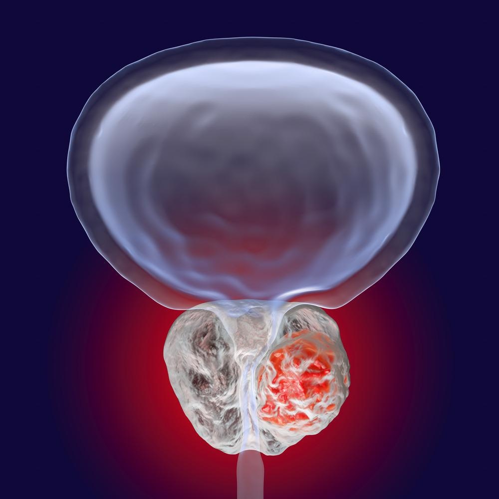 Prostate Cancer