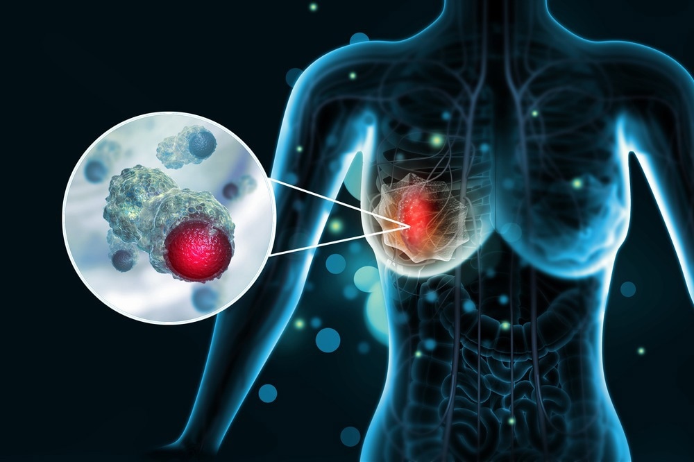 Breast Cancer Cells
