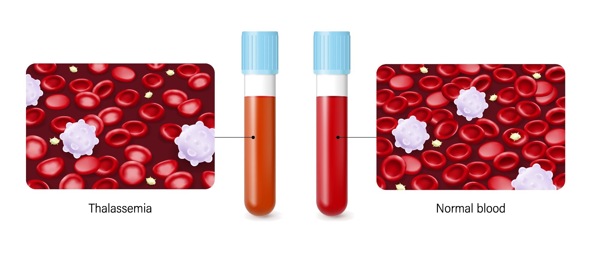 alpha thalassemia