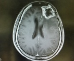 Role of Spectroscopy in Glioblastoma Diagnosis