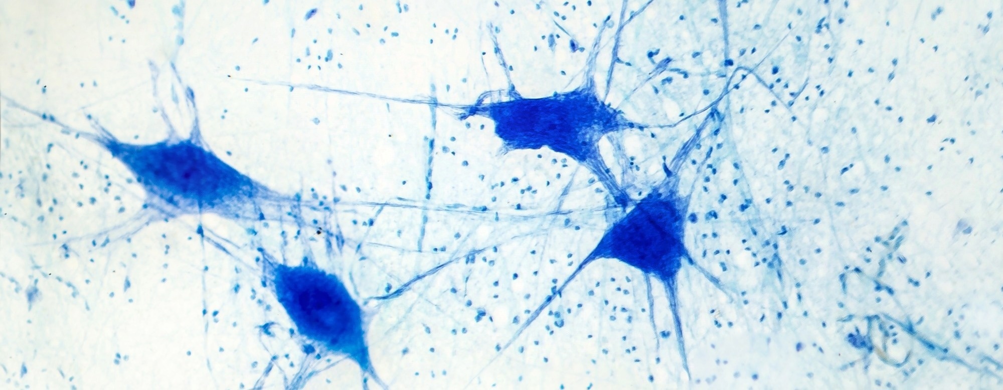 Parkinson’s Gene Mutation Blocks Vital Neuroprotective Signals