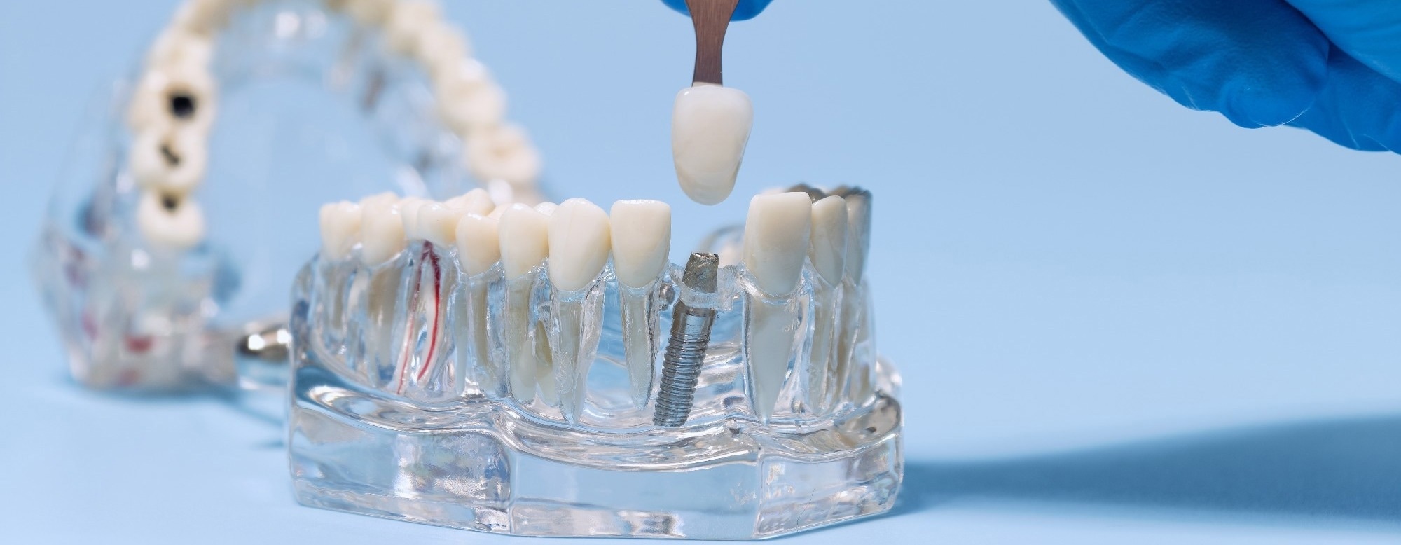 Built Oral Biofilm Models Reveal How Peri-Implantitis Develops