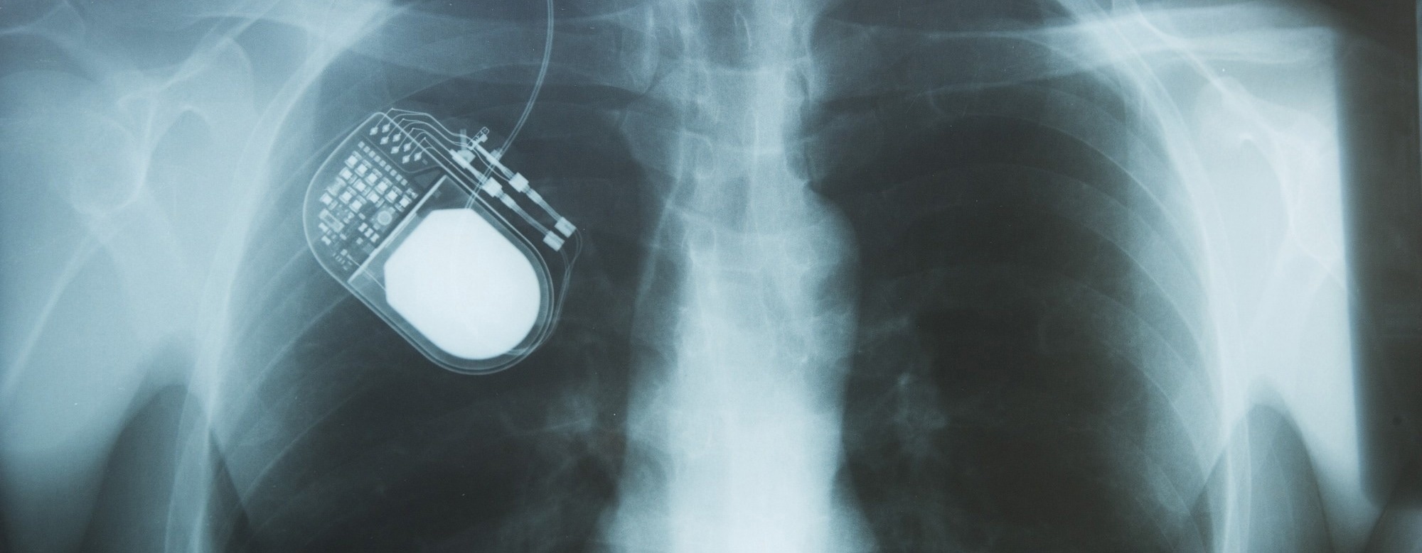 Smart Implants and Closed-Loop Systems: The Next Generation of Therapeutic Devices