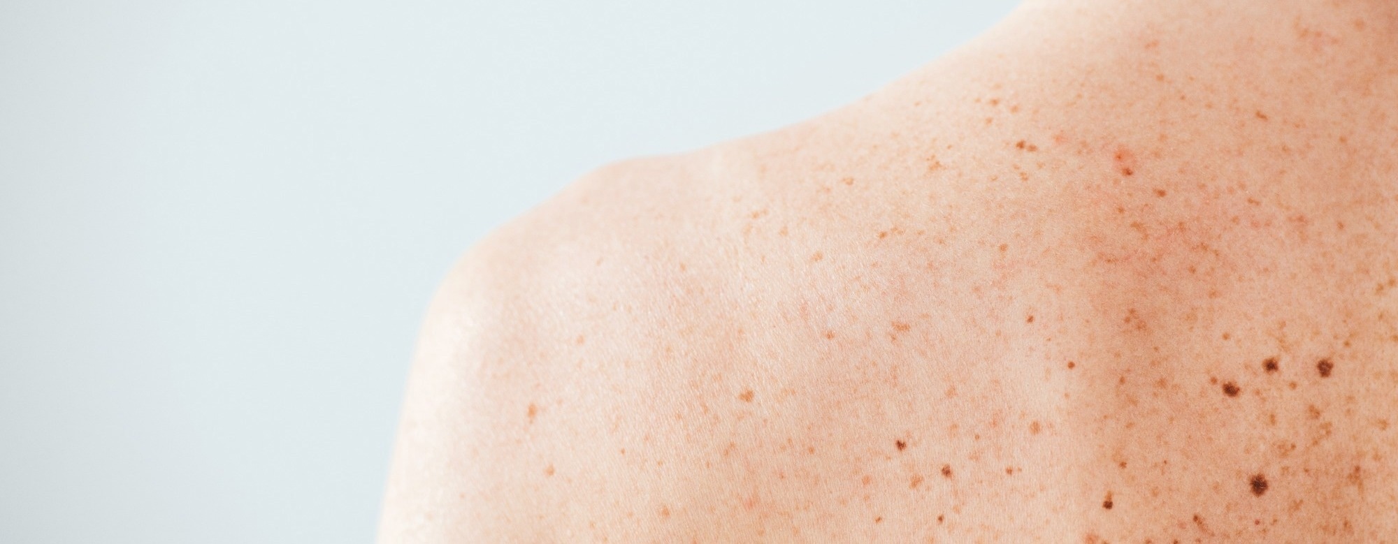 Psoriasis-Like Inflammation Limits Skin Cancer Growth