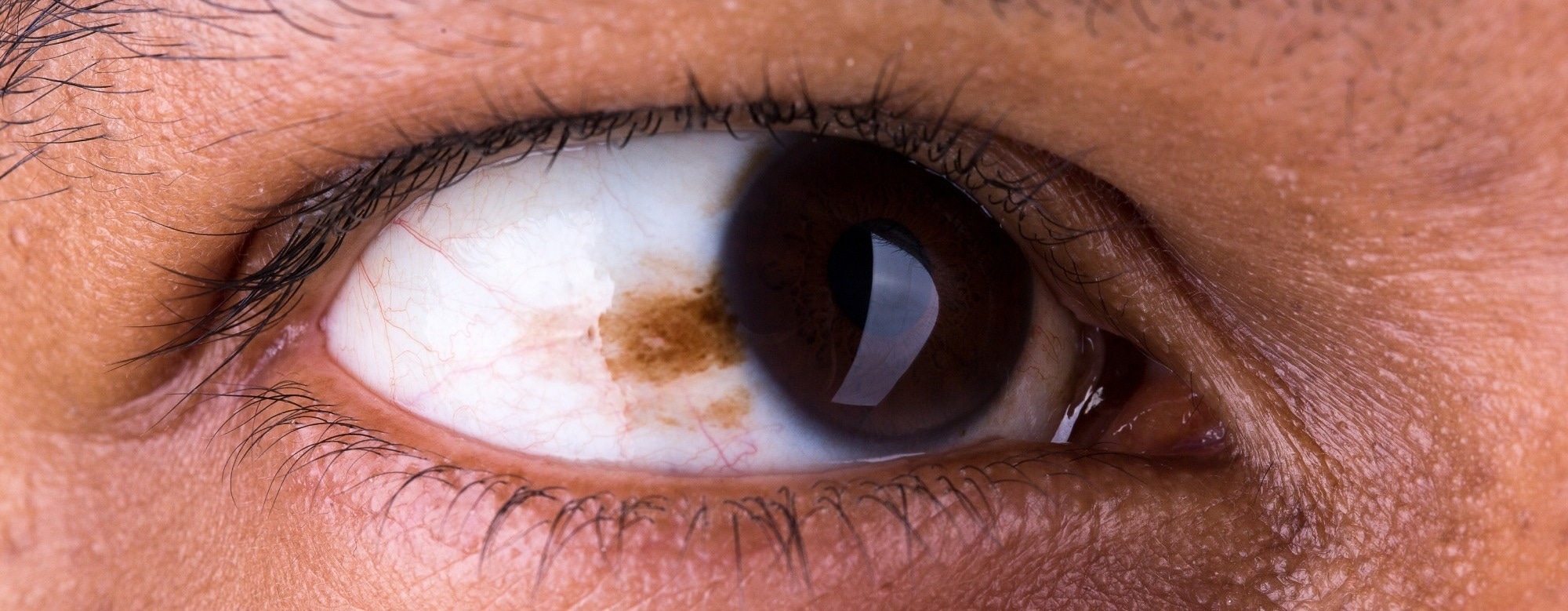 Semen-Derived Exosomes Eye Drops to Treat Retinoblastoma