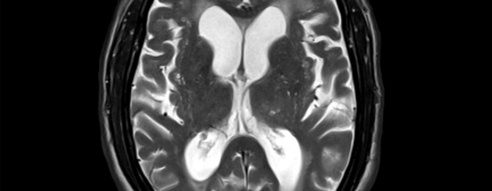 A Possible Brain Fluid Recycling System In Humans