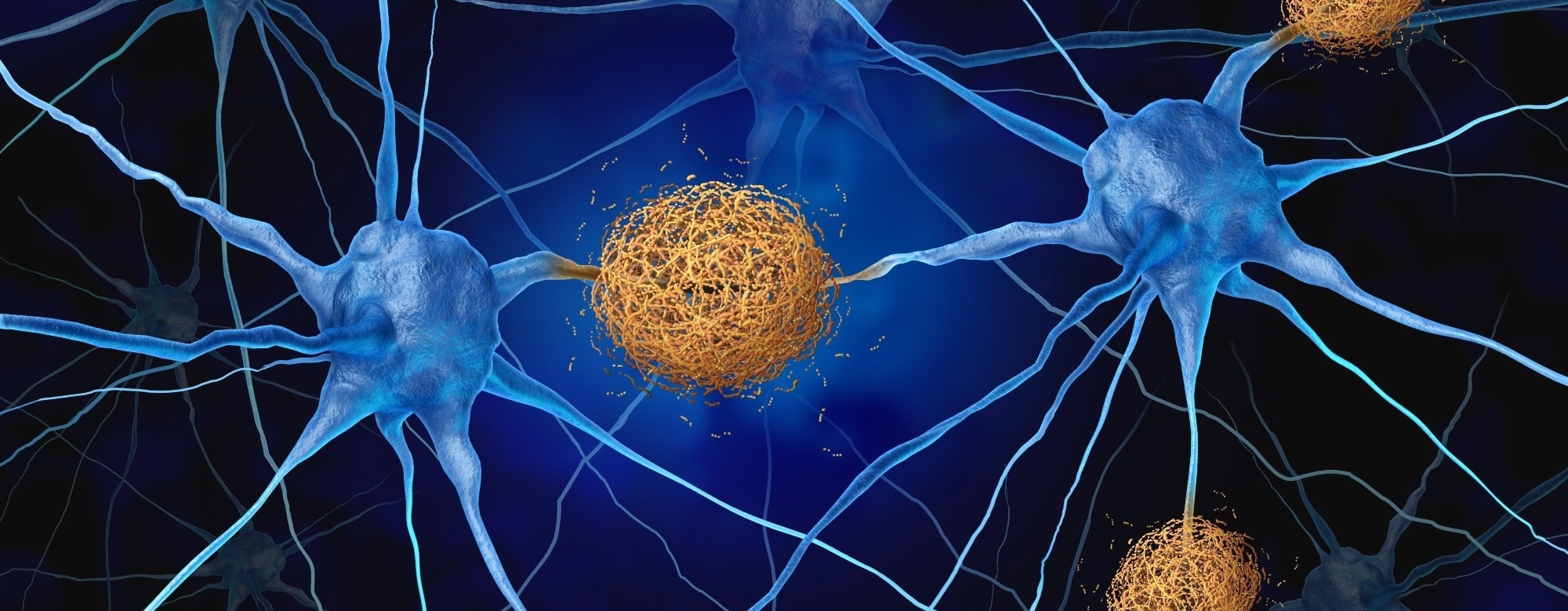 Arc Protein Identified as Driving Tau Spread in Alzheimer's Disease