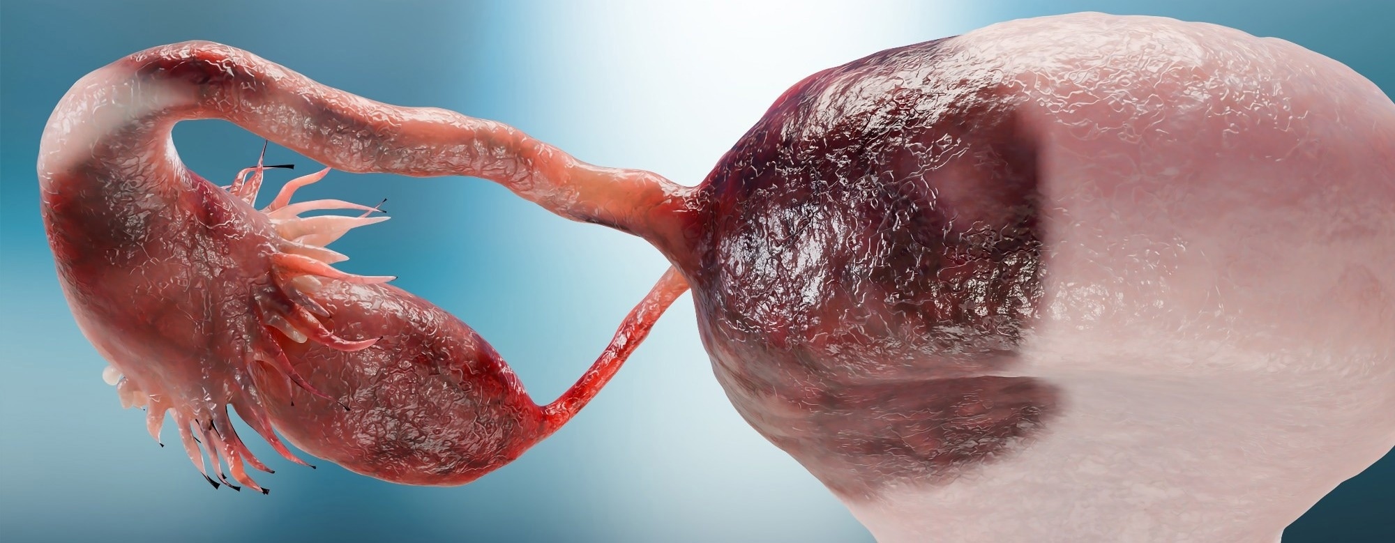 USP15 Protein May Help Ovarian Cancer Resist Chemotherapy