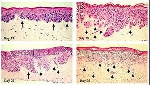 Melanoma