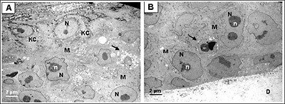 Melanoma