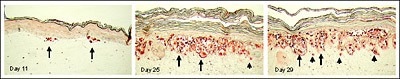 Melanoma