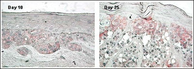 Melanoma