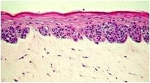 Melanoma