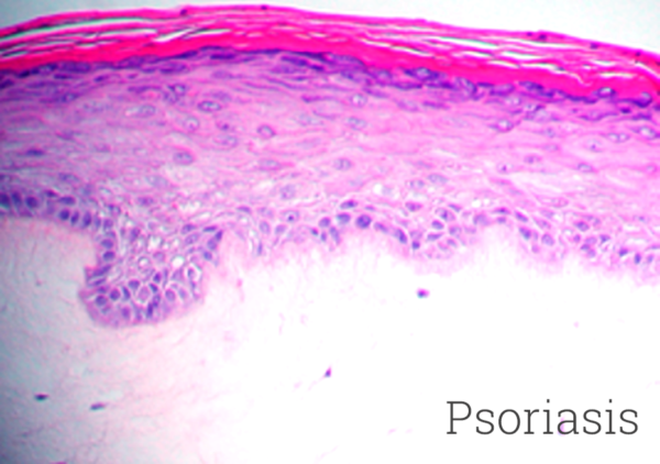 Psoriasis