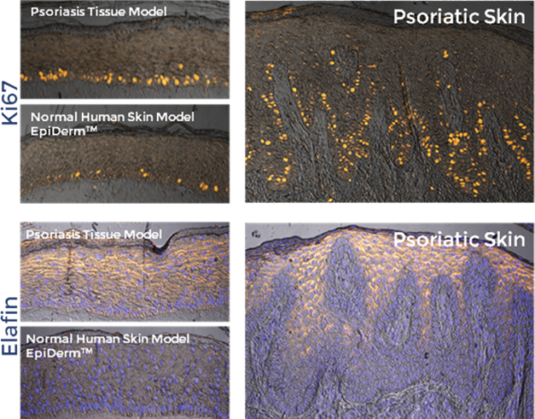 Psoriasis