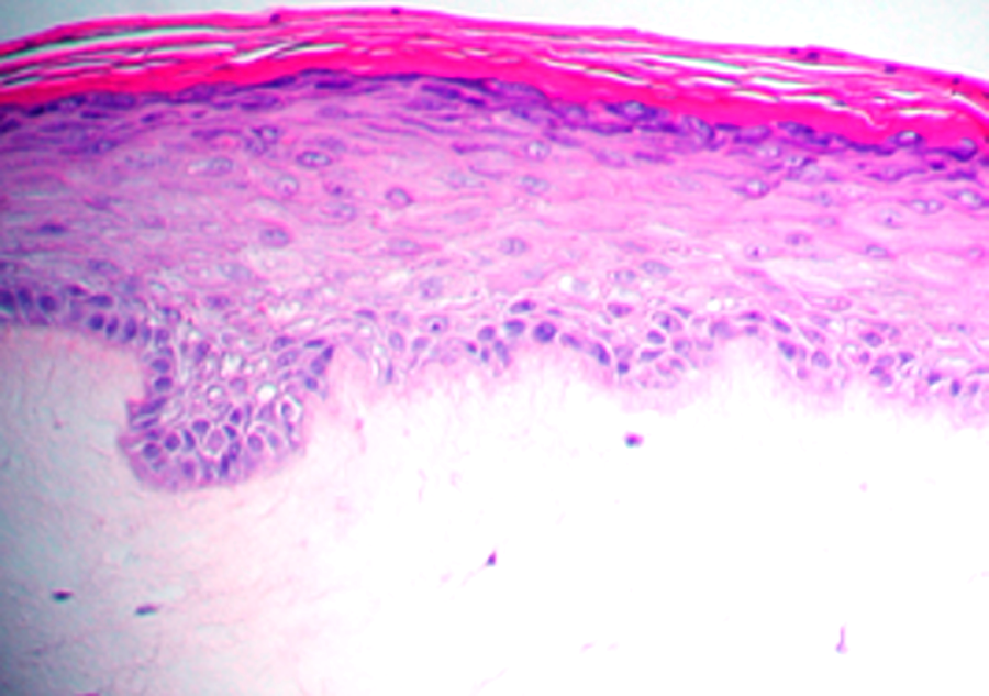 Psoriasis