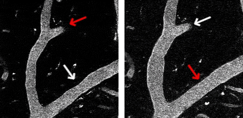 Two-photon activation leads to focal constriction. The SLM focused six spots at the location indicated by the red arrow. The total stimulation power was ~ 200 mW spread over the six spots, with three adjacent spots on either side of the vessel. Each spot was scanned in a 12 μm diameter spiral for 100 ms. The white arrow is for comparison. Vessels are labeled with Texas Red Dextran. Speed 4x real time