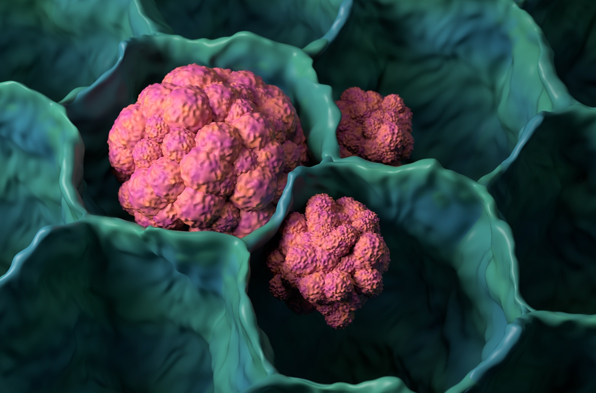 Lung cancer tumor microbiology 3d illustration closeup view
