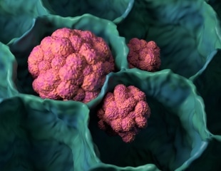 How Cancer Cells Physically Adapt to Survive Within Bodies