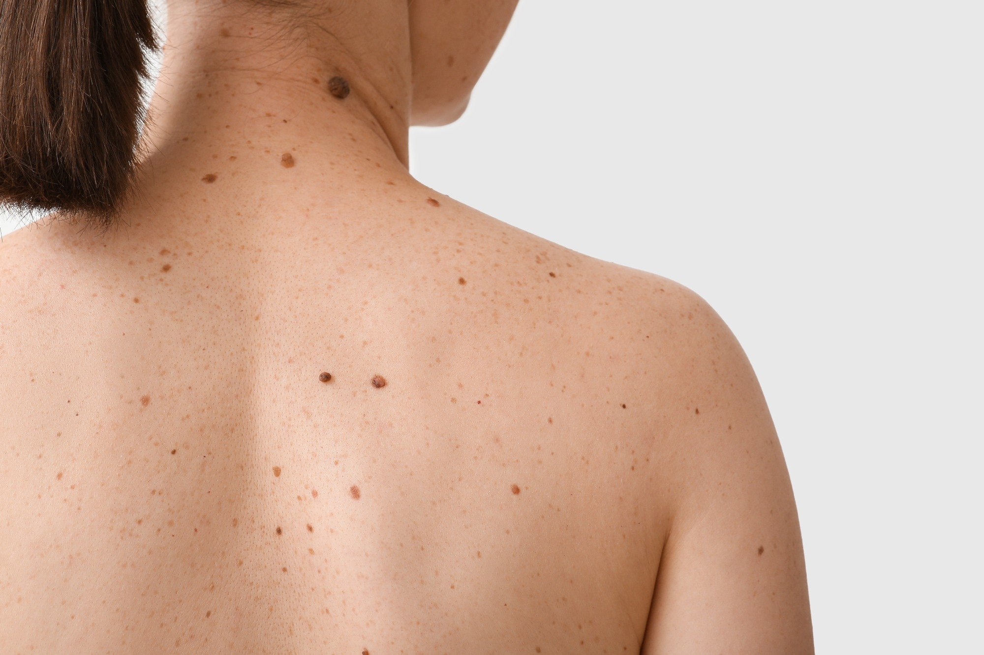 Woman with moles on her back against white background, closeup