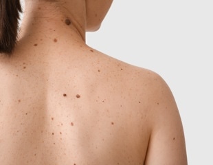 Single-cell atlas reveals how melanoma evades the immune system