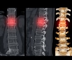 Bone-building hormone eases chronic low back pain by restoring vertebral microarchitecture