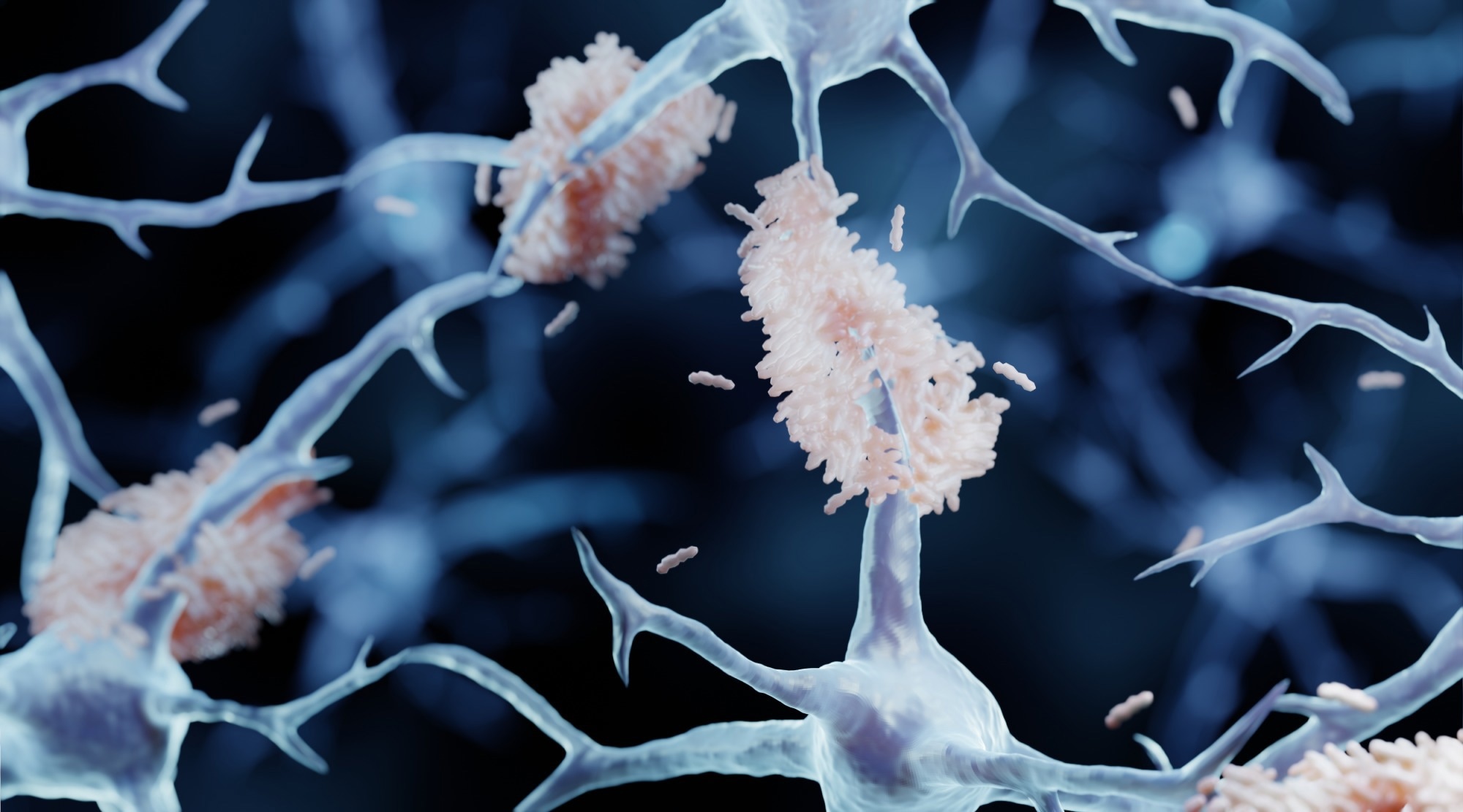 Amyloid plaque forming between neurons in Alzheimer