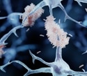 DNA Changes in Alzheimer’s That May Drive Disease Progression