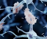 DNA Changes in Alzheimer’s That May Drive Disease Progression